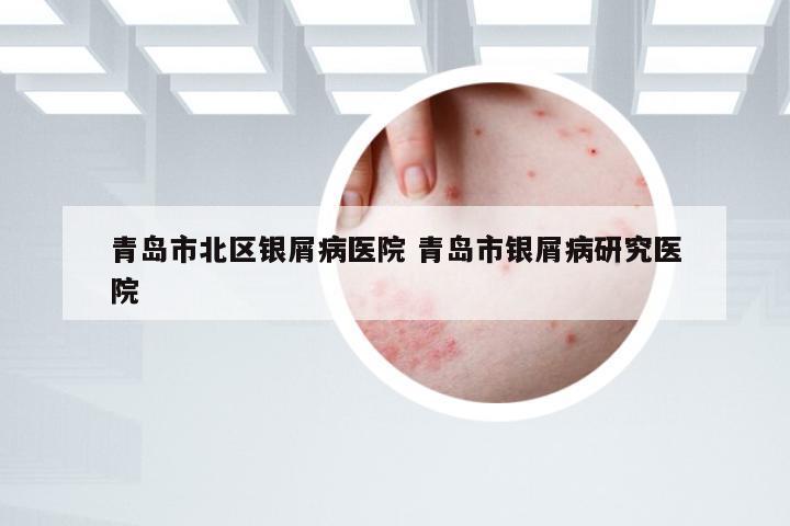 青岛市北区银屑病医院 青岛市银屑病研究医院