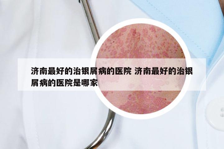 济南最好的治银屑病的医院 济南最好的治银屑病的医院是哪家