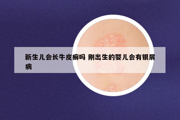 新生儿会长牛皮癣吗 刚出生的婴儿会有银屑病