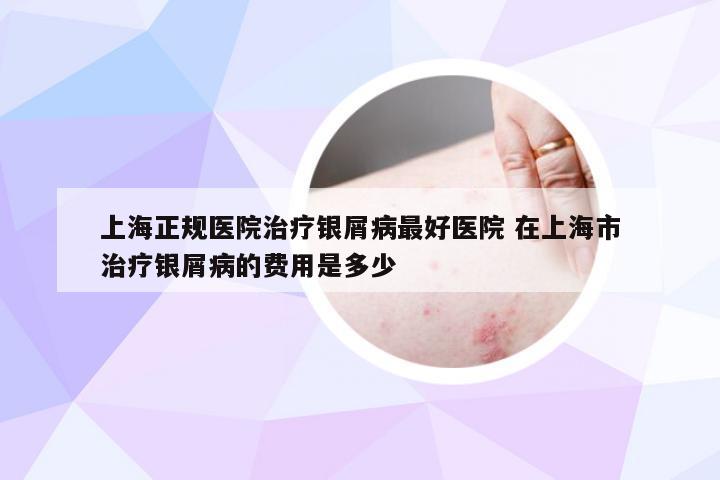 上海正规医院治疗银屑病最好医院 在上海市治疗银屑病的费用是多少