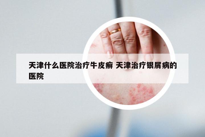 天津什么医院治疗牛皮癣 天津治疗银屑病的医院