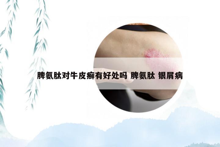脾氨肽对牛皮癣有好处吗 脾氨肽 银屑病