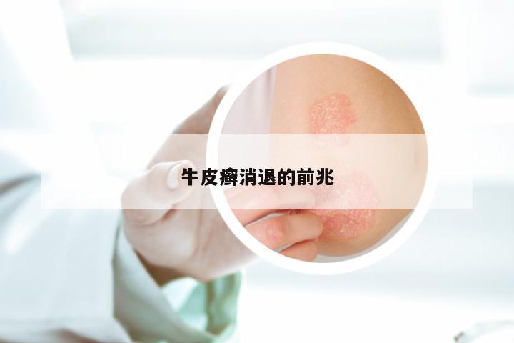 牛皮癣消退的前兆