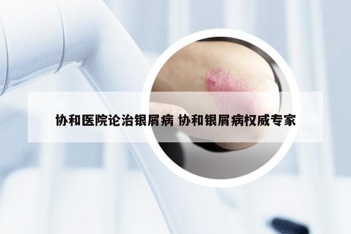 协和医院论治银屑病 协和银屑病权威专家