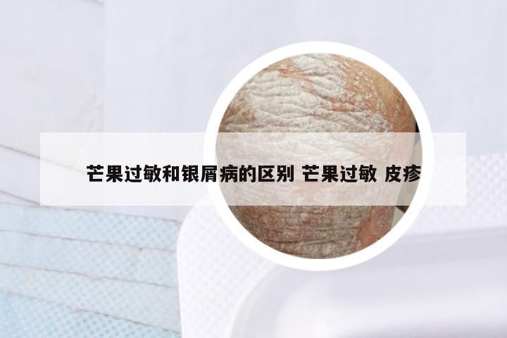 芒果过敏和银屑病的区别 芒果过敏 皮疹