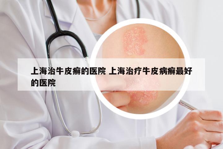 上海治牛皮癣的医院 上海治疗牛皮病癣最好的医院