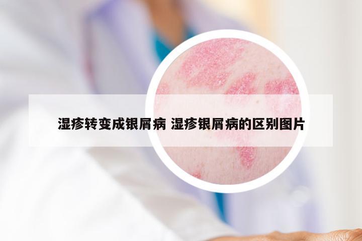 湿疹转变成银屑病 湿疹银屑病的区别图片