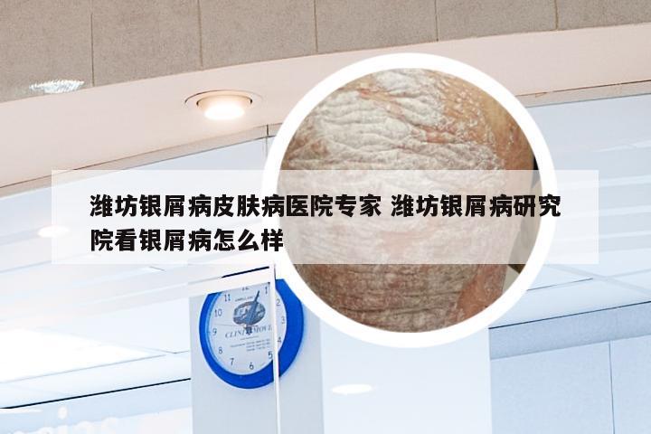 潍坊银屑病皮肤病医院专家 潍坊银屑病研究院看银屑病怎么样