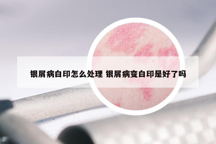 银屑病白印怎么处理 银屑病变白印是好了吗