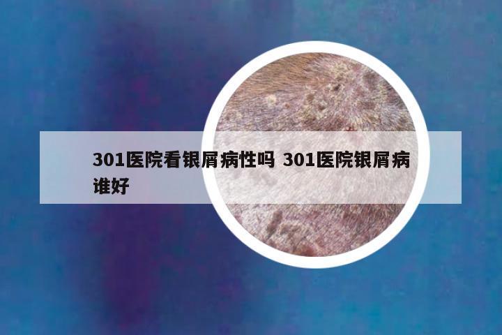 301医院看银屑病性吗 301医院银屑病谁好