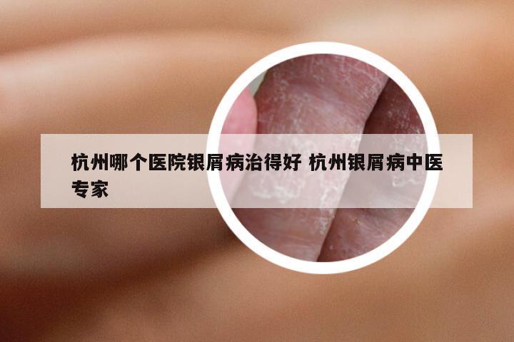杭州哪个医院银屑病治得好 杭州银屑病中医专家