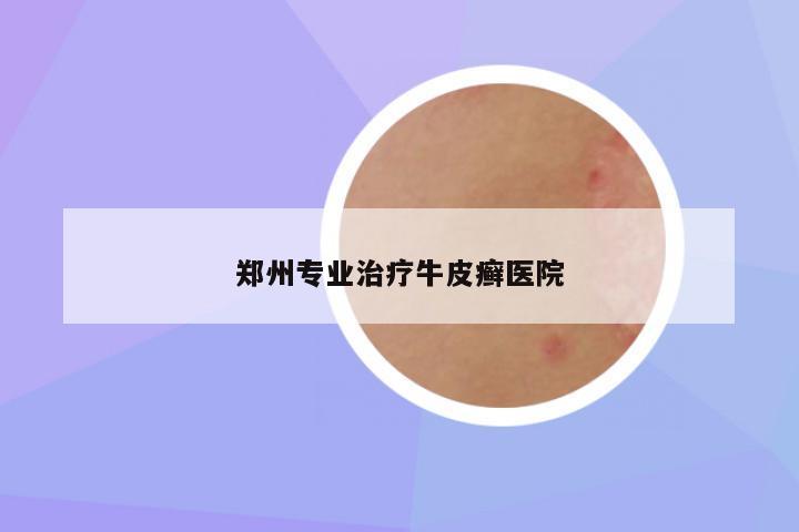郑州专业治疗牛皮癣医院