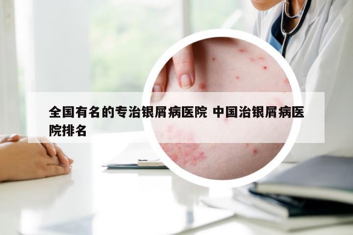 全国有名的专治银屑病医院 中国治银屑病医院排名