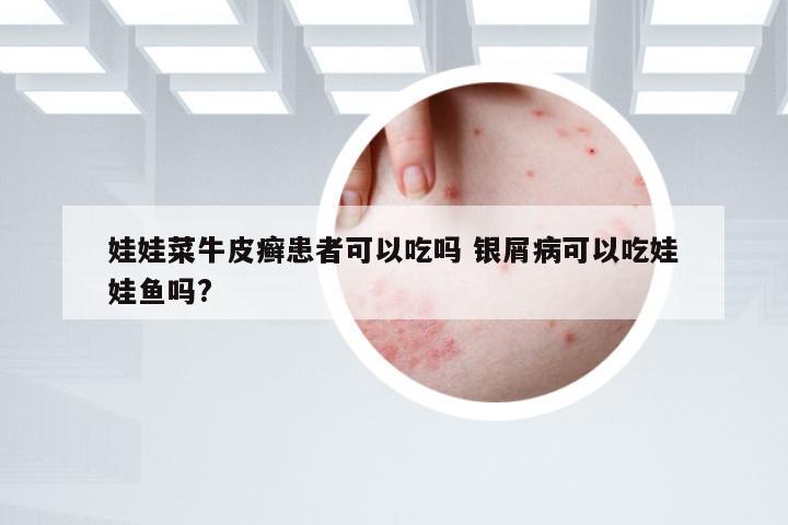娃娃菜牛皮癣患者可以吃吗 银屑病可以吃娃娃鱼吗?