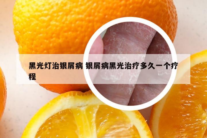 黑光灯治银屑病 银屑病黑光治疗多久一个疗程