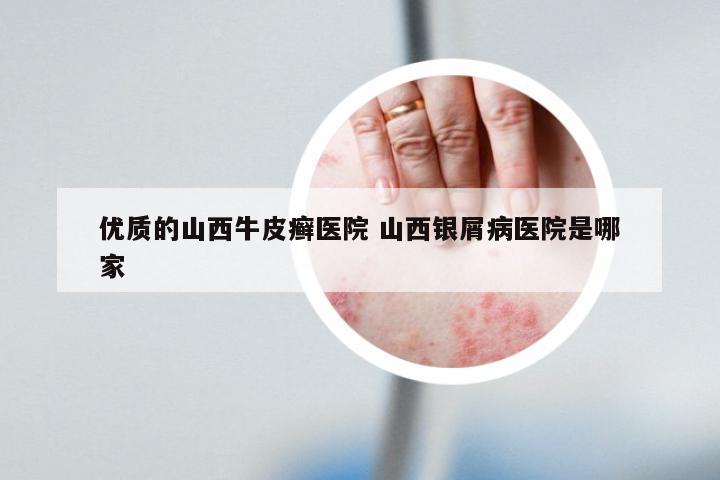 优质的山西牛皮癣医院 山西银屑病医院是哪家