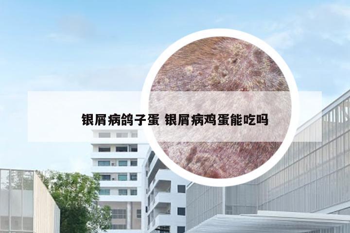 银屑病鸽子蛋 银屑病鸡蛋能吃吗