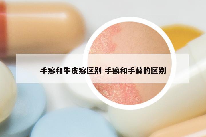 手癣和牛皮癣区别 手癣和手藓的区别