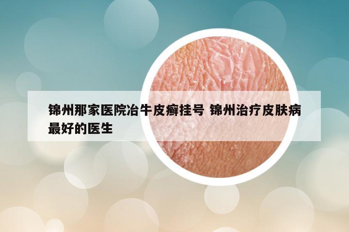 锦州那家医院冶牛皮癣挂号 锦州治疗皮肤病最好的医生