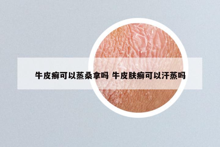 牛皮癣可以蒸桑拿吗 牛皮肤癣可以汗蒸吗