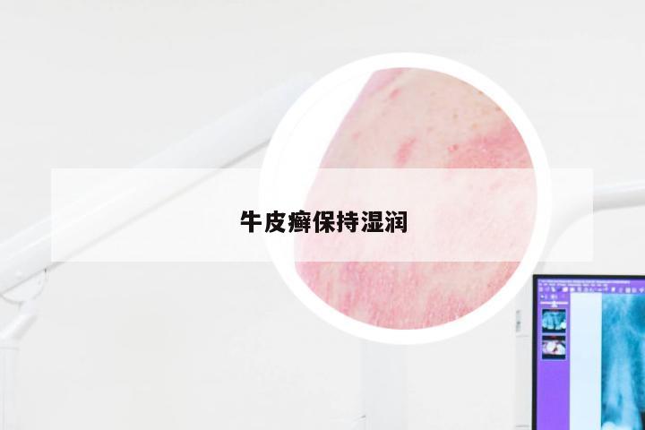 牛皮癣保持湿润