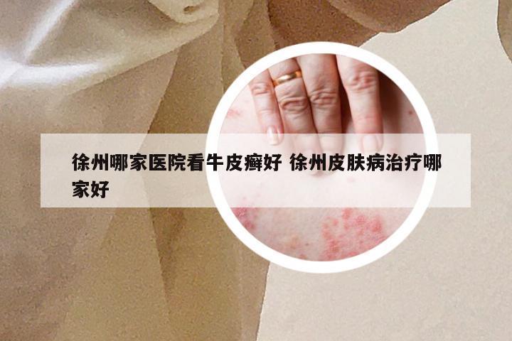 徐州哪家医院看牛皮癣好 徐州皮肤病治疗哪家好
