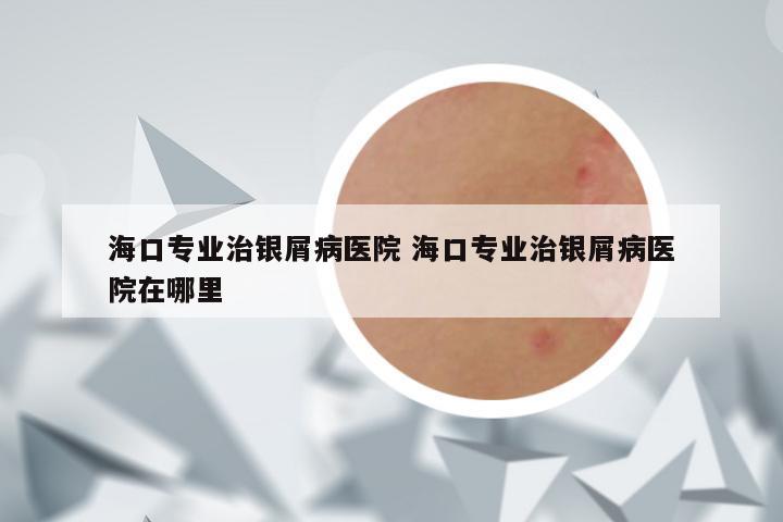 海口专业治银屑病医院 海口专业治银屑病医院在哪里