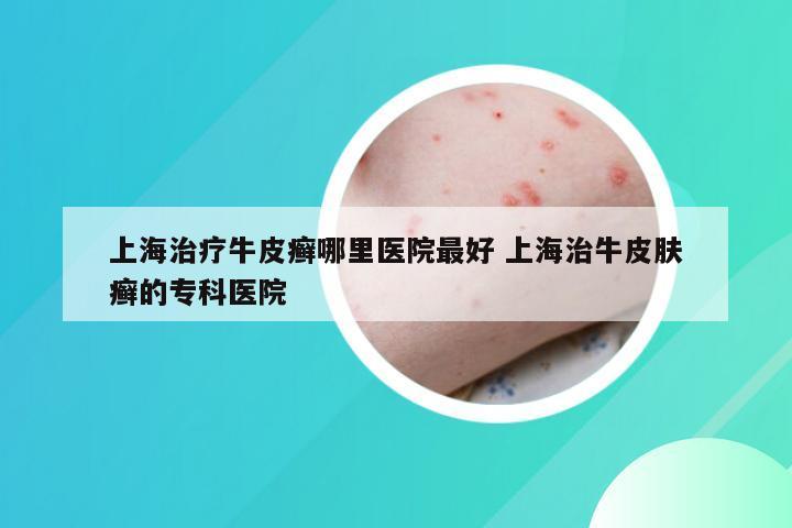 上海治疗牛皮癣哪里医院最好 上海治牛皮肤癣的专科医院