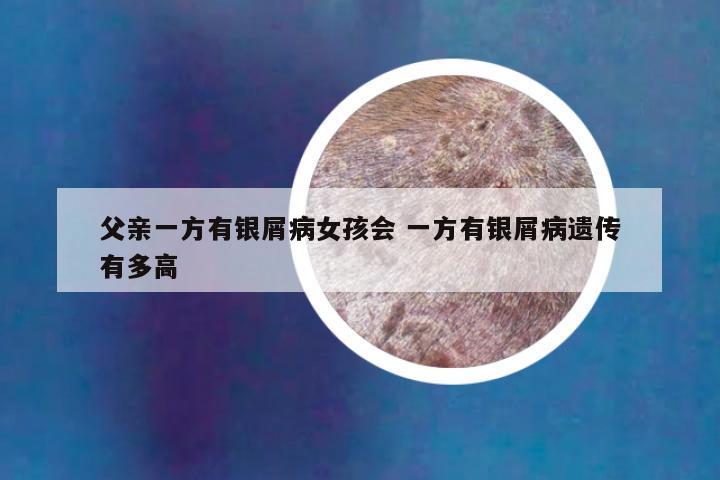 父亲一方有银屑病女孩会 一方有银屑病遗传有多高