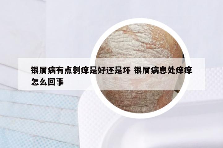 银屑病有点刺痒是好还是坏 银屑病患处痒痒怎么回事