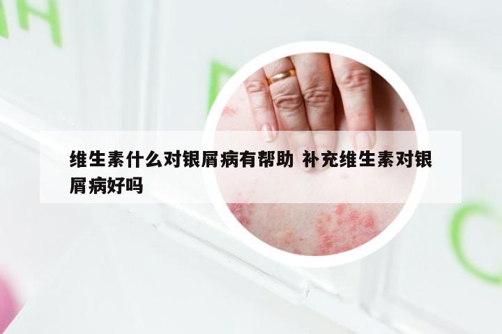 维生素什么对银屑病有帮助 补充维生素对银屑病好吗