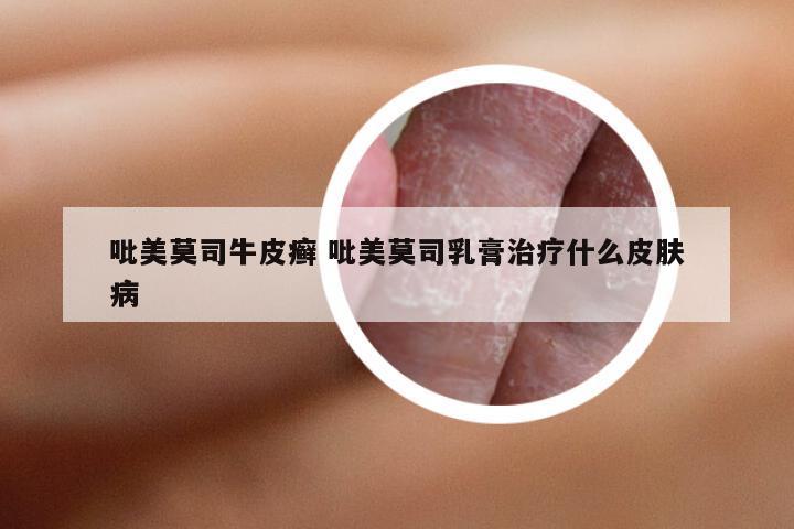 吡美莫司牛皮癣 吡美莫司乳膏治疗什么皮肤病