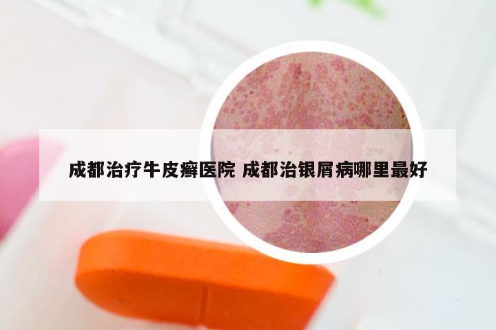 成都治疗牛皮癣医院 成都治银屑病哪里最好