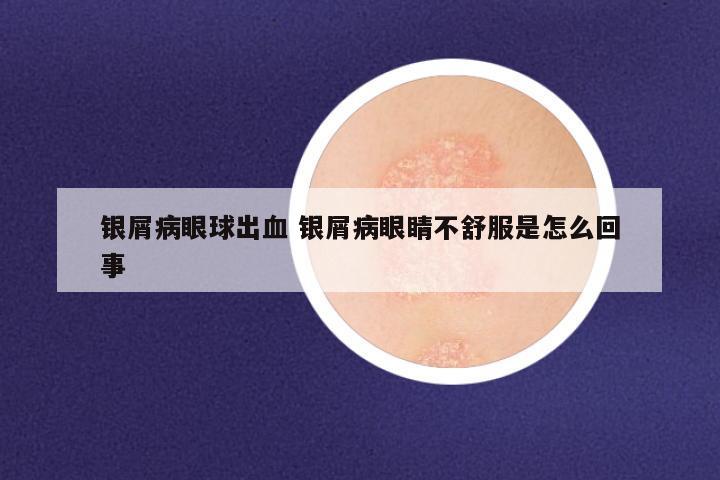 银屑病眼球出血 银屑病眼睛不舒服是怎么回事