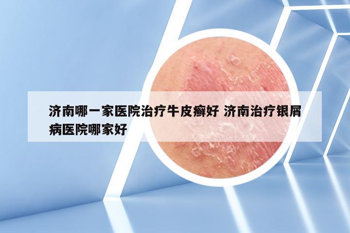 济南哪一家医院治疗牛皮癣好 济南治疗银屑病医院哪家好