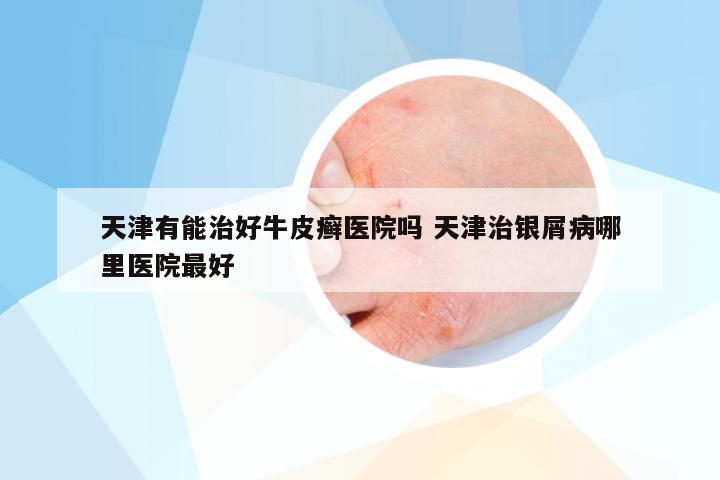 天津有能治好牛皮癣医院吗 天津治银屑病哪里医院最好
