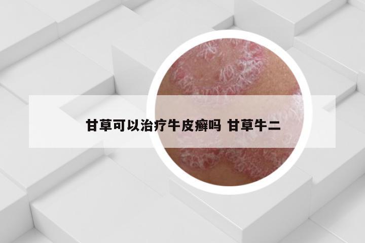 甘草可以治疗牛皮癣吗 甘草牛二
