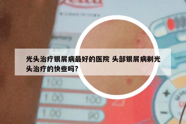 光头治疗银屑病最好的医院 头部银屑病剃光头治疗的快些吗?