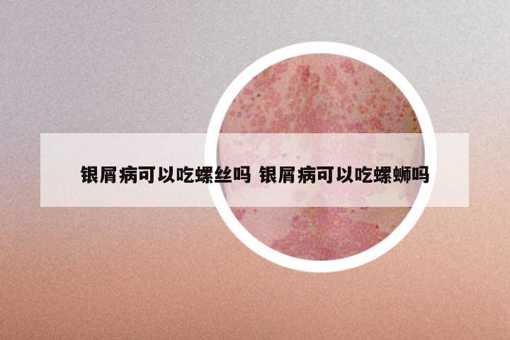 银屑病可以吃螺丝吗 银屑病可以吃螺蛳吗