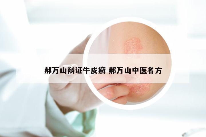 郝万山辩证牛皮癣 郝万山中医名方