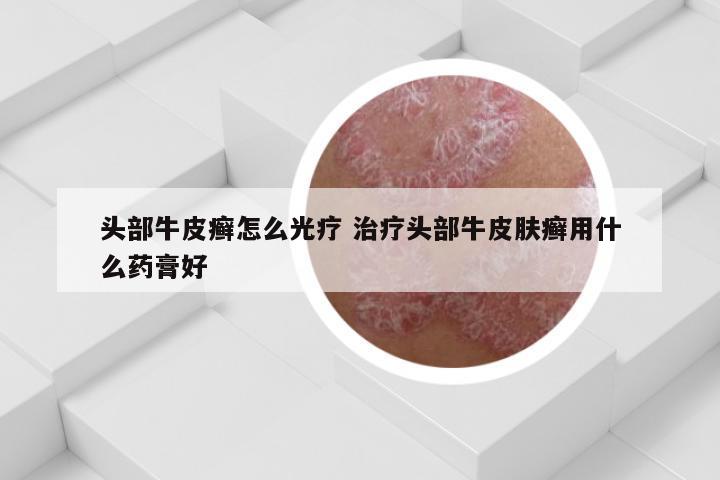 头部牛皮癣怎么光疗 治疗头部牛皮肤癣用什么药膏好