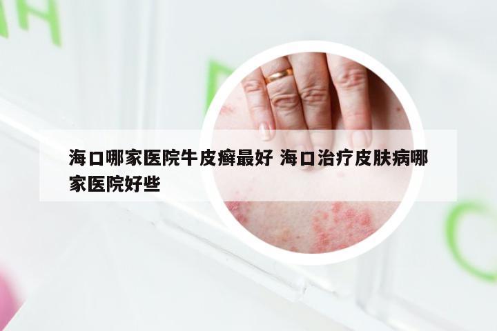 海口哪家医院牛皮癣最好 海口治疗皮肤病哪家医院好些