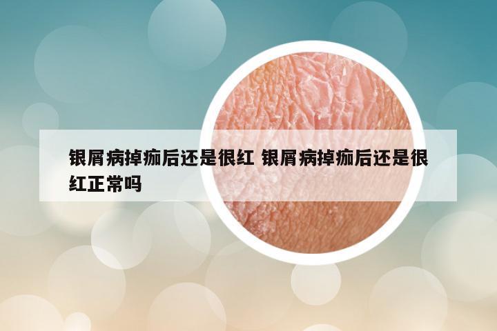 银屑病掉痂后还是很红 银屑病掉痂后还是很红正常吗