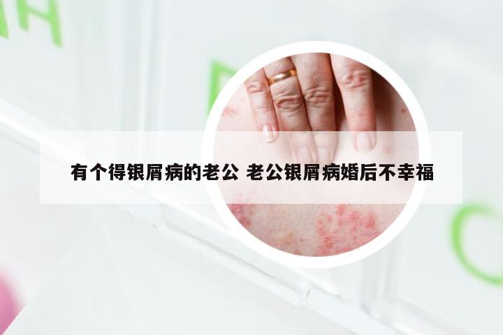 有个得银屑病的老公 老公银屑病婚后不幸福