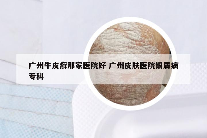 广州牛皮癣那家医院好 广州皮肤医院银屑病专科
