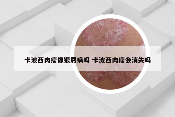 卡波西肉瘤像银屑病吗 卡波西肉瘤会消失吗