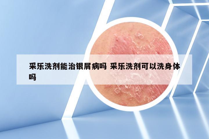 采乐洗剂能治银屑病吗 采乐洗剂可以洗身体吗