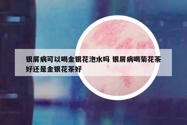 银屑病可以喝金银花泡水吗 银屑病喝菊花茶好还是金银花茶好