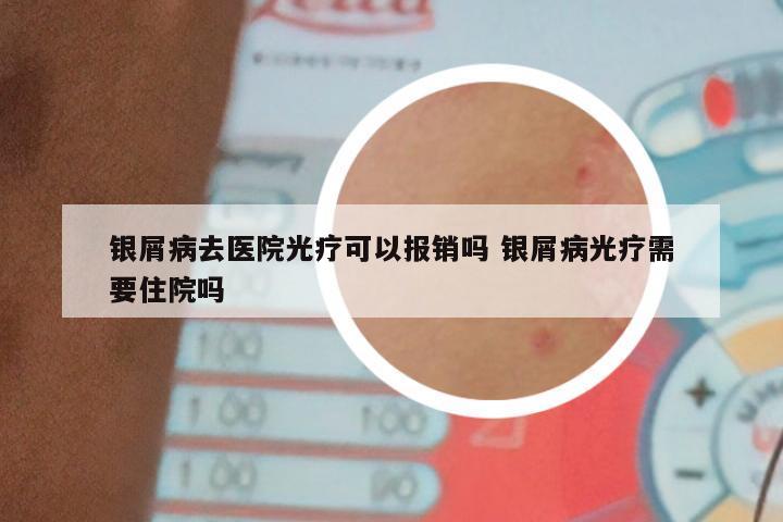 银屑病去医院光疗可以报销吗 银屑病光疗需要住院吗