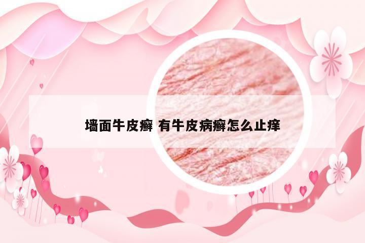 墙面牛皮癣 有牛皮病癣怎么止痒